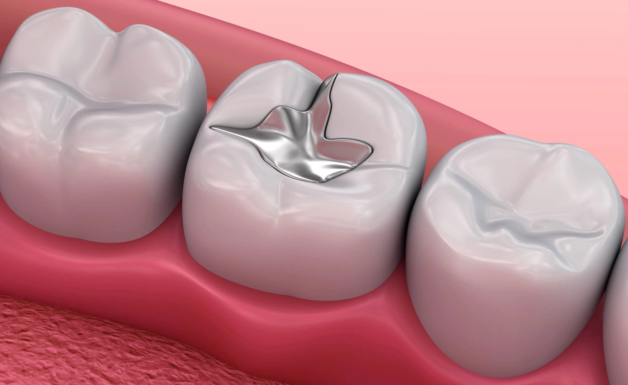 3D image of affordable dental fillings clawson