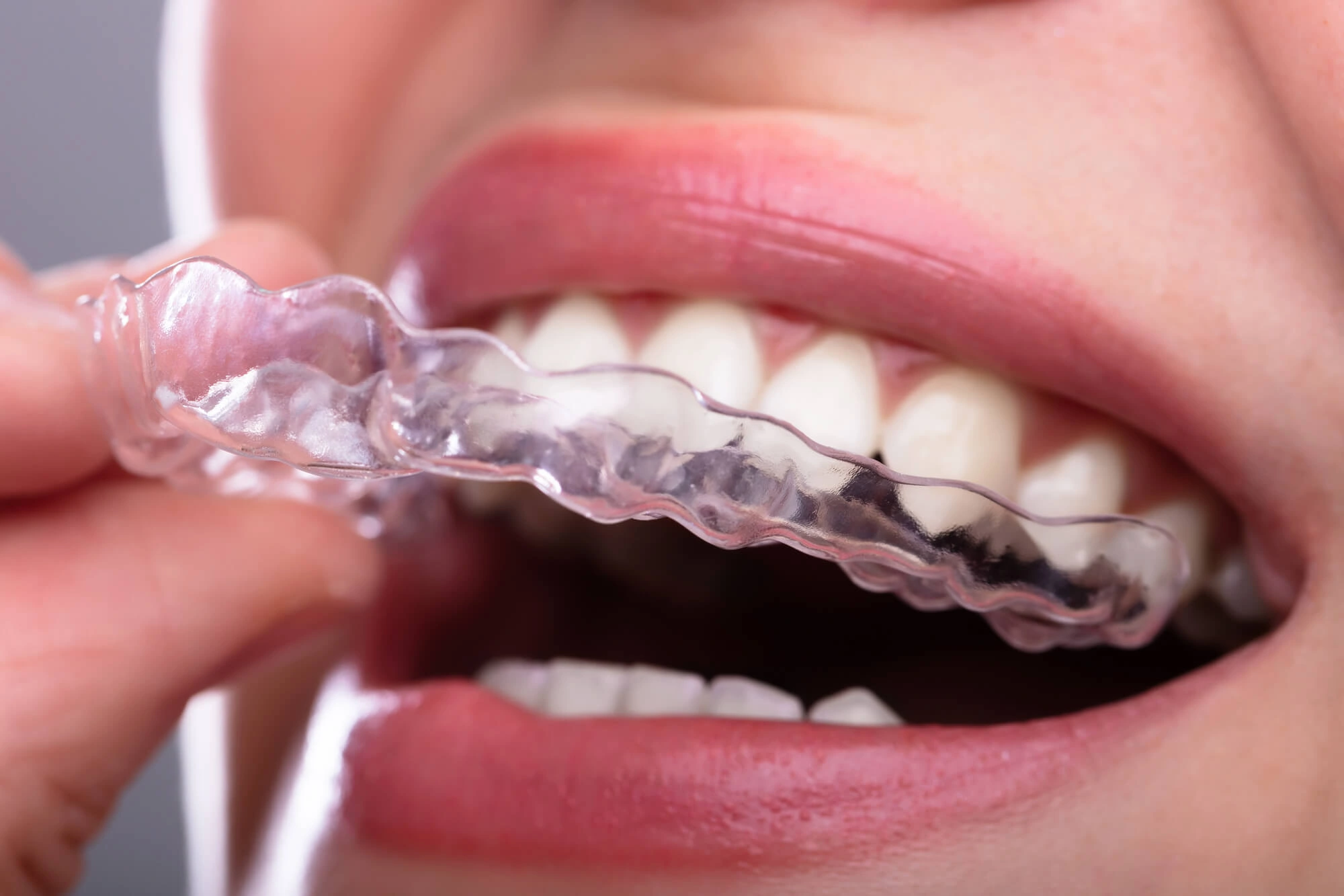 Wearing-Clear-aligners-Clawson-MI