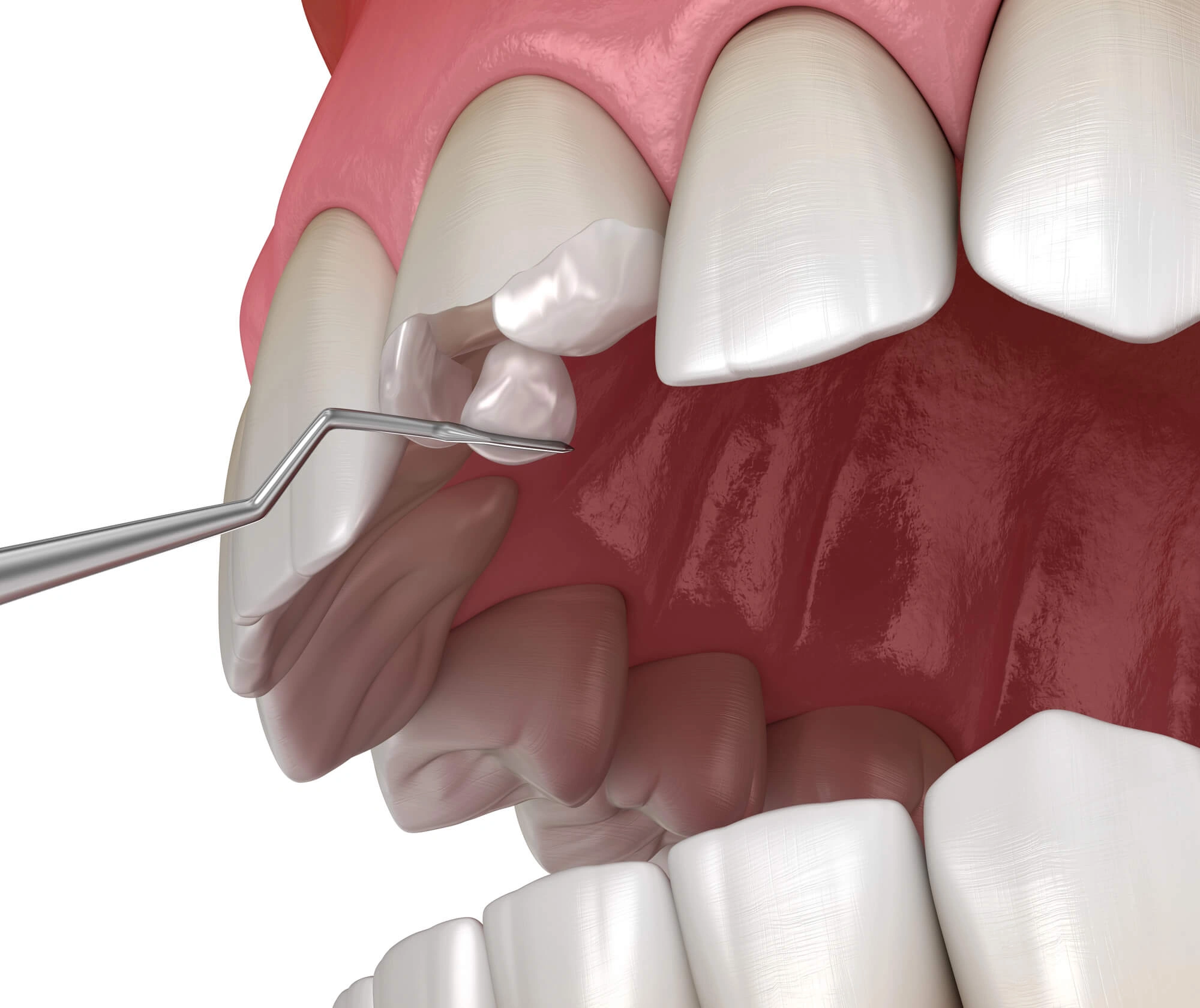Chipped teeth needs emergency dentist detroit