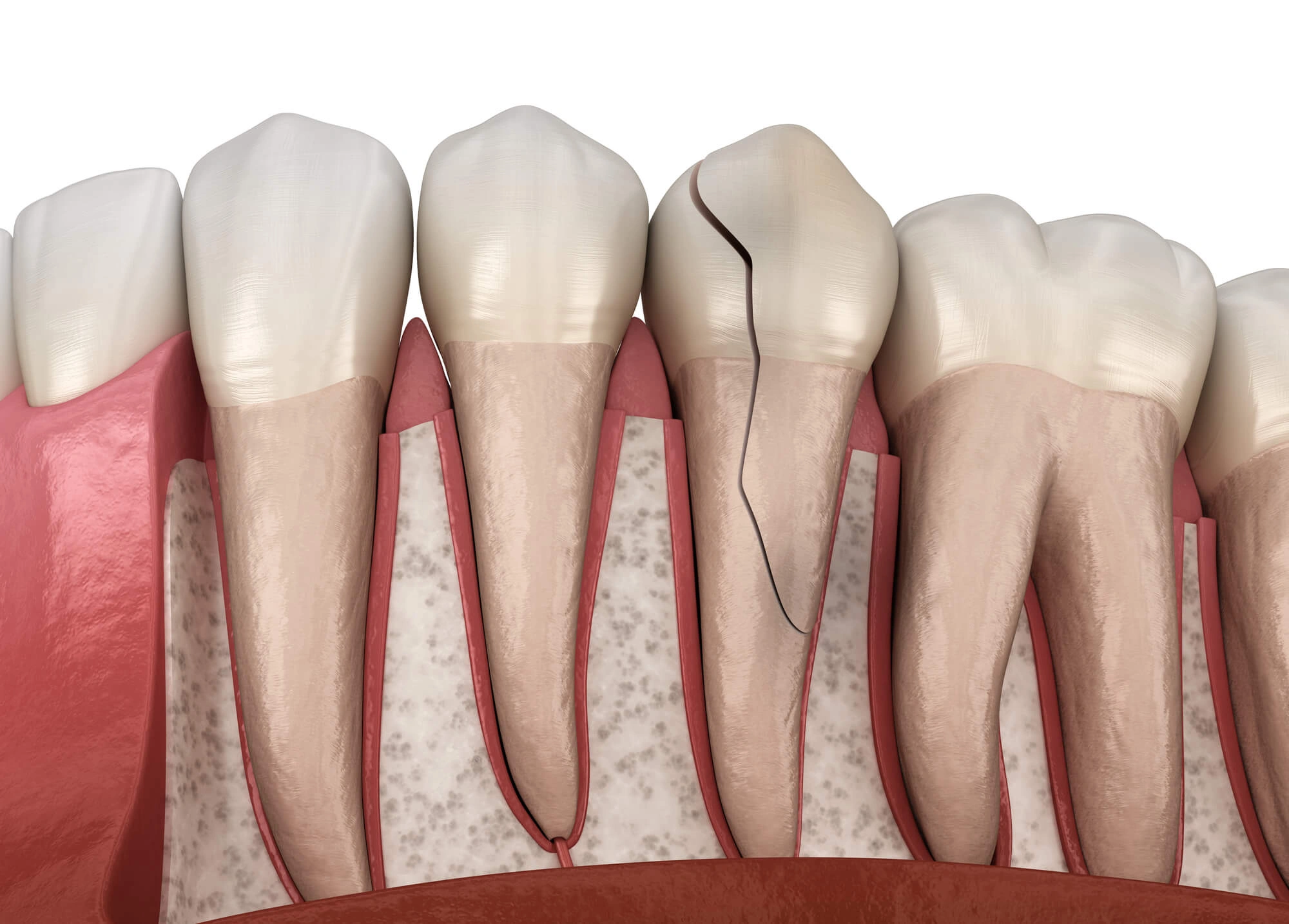 Cracked tooth needs emergency dentist detroit