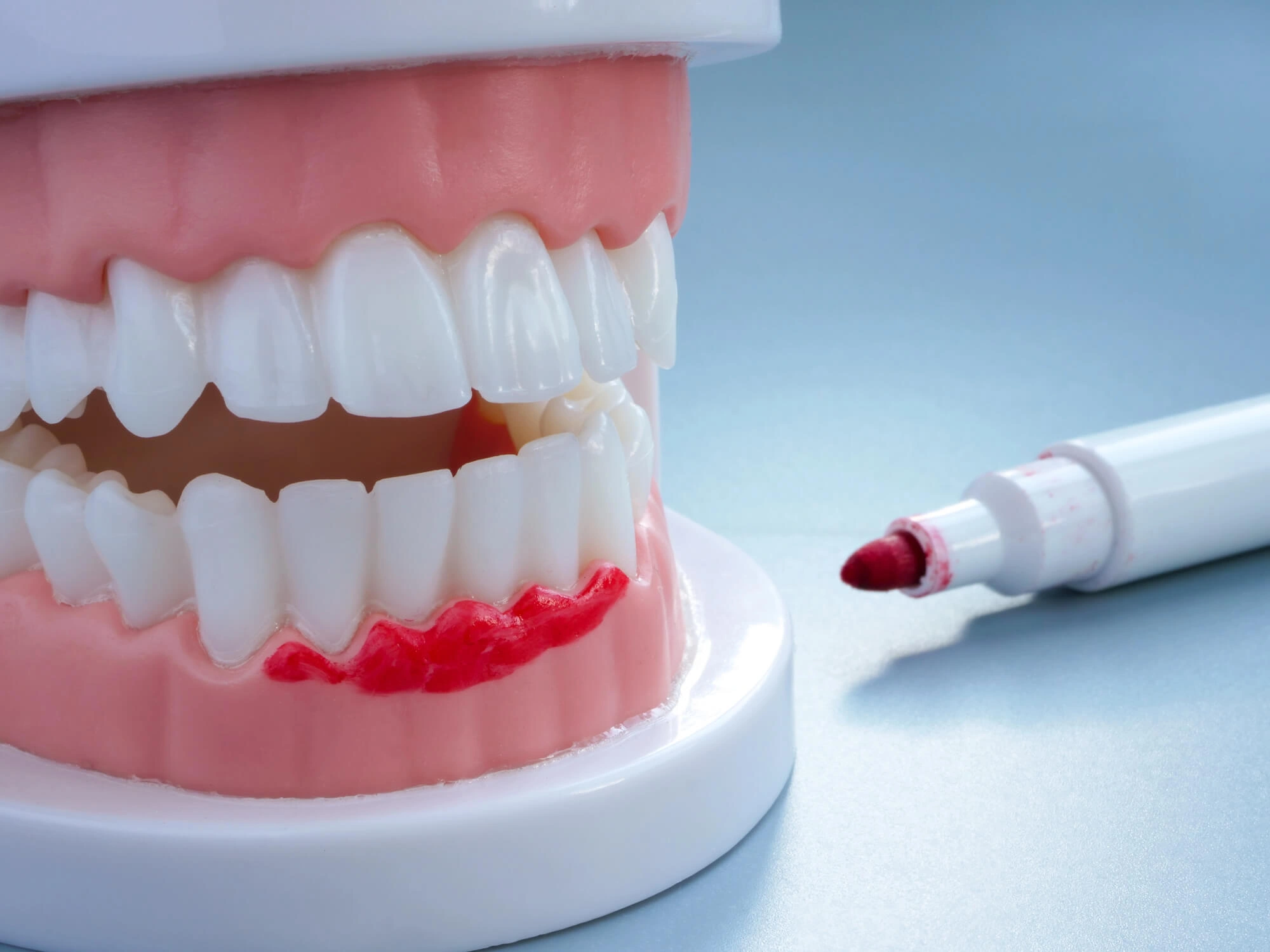 Swollen gums model by dentist greenfield